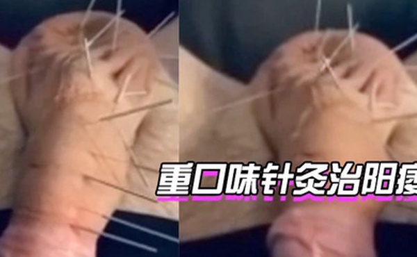 针灸治阳痿你想试下吗